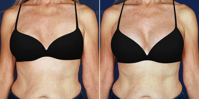 What To Expect Before And After A Breast Augmentation Henof 0362