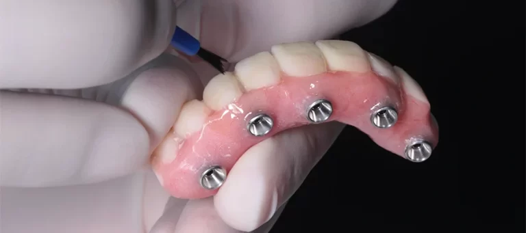 All on 4: Transforming Smiles with Innovative Dental Implants